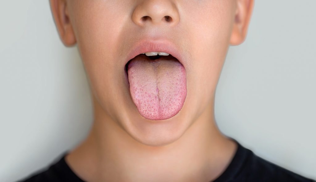 pleśniawki w jamie ustnej